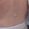 A 2-mm black macule on the mid-back located approximately 1 cm from the original melanoma excision scar line.